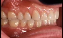 Diş Sıkma Alışkanlık Haline Geldiğinde Zararlıdır