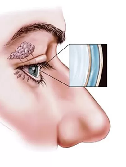 Kuru Göz Sendromu Nedir?
