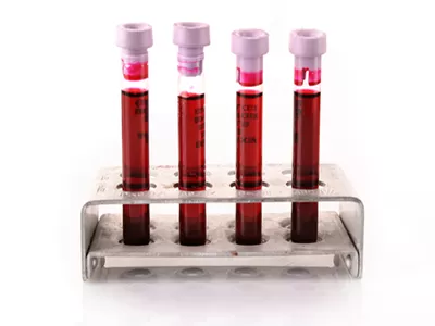 Anti-dsDNA Testi SLE Tanısında Önemlidir