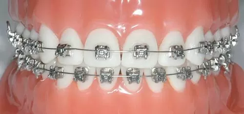 Ortodontik Diş Tedavisi Nedir?