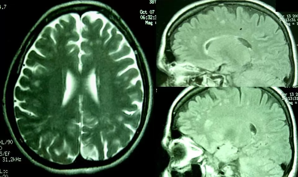 Apopleksi Serebral: Beyin İnmesi Nedir?