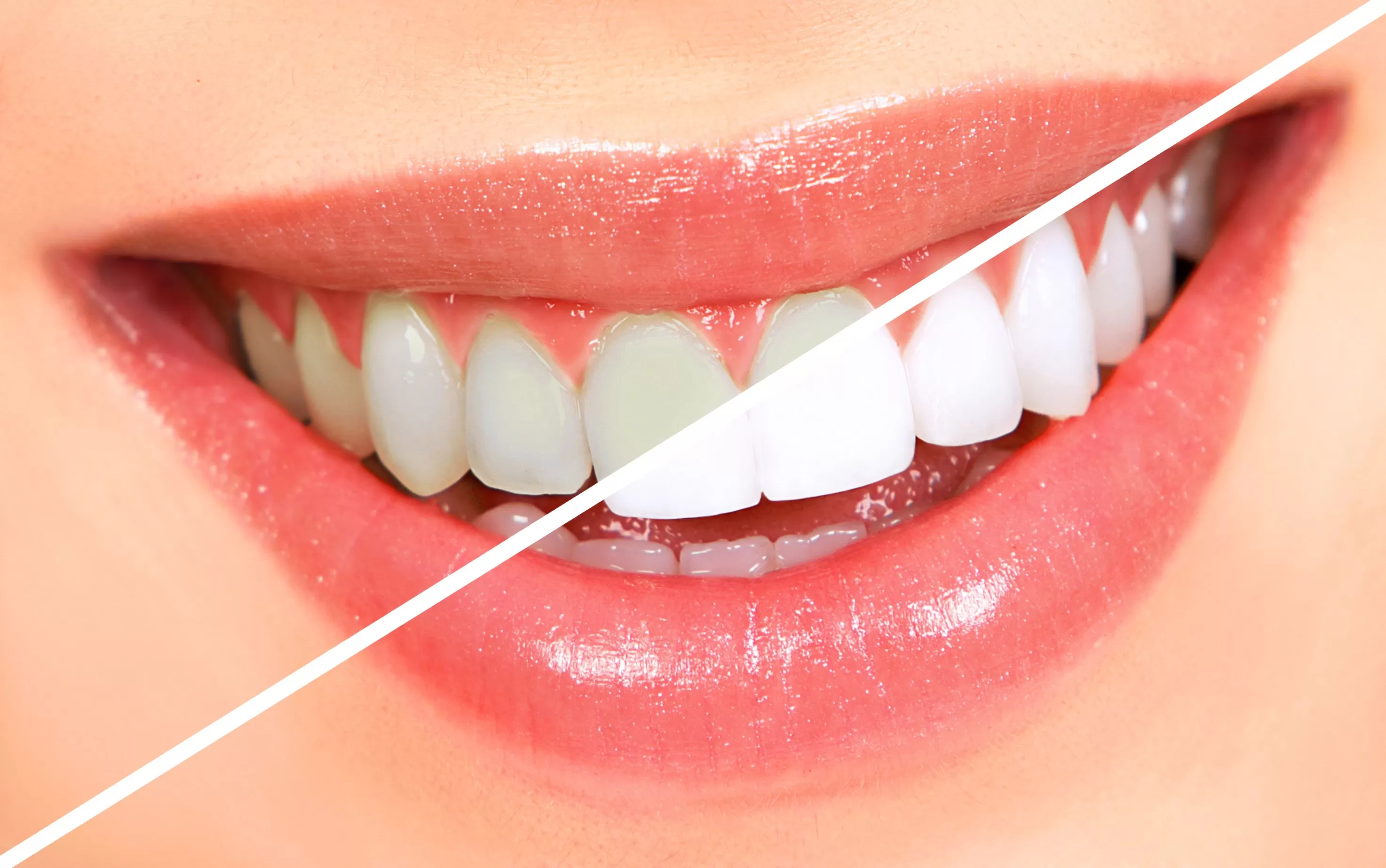 Dişleri Beyazlatmak İçin Ne Yapılabilir?
