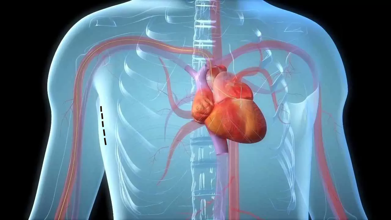 Kalp Kapak Hastalıkları Nasıl Tedavi Edilir?