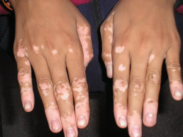 Vitiligo Hastalığı Nedir? Belirtileri Nelerdir?