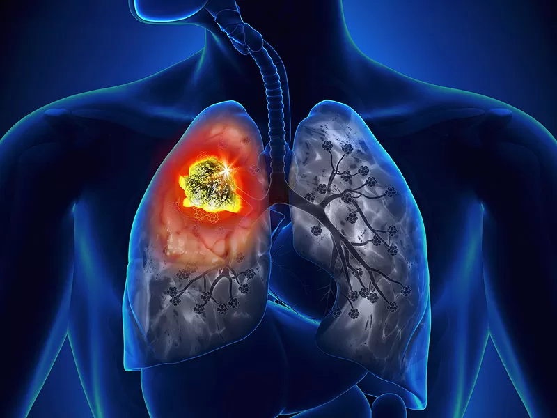 Akciğer Kanseri ve Akciğer Kanserinde Cerrahi Tedavi :Akciğere Bıçak Değer mi?