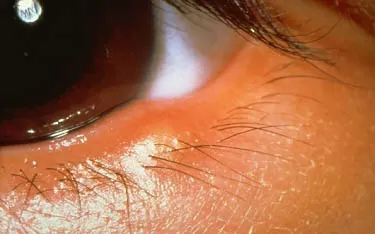 Blefarit Göz Hastalığının Belirtileri Nelerdir?