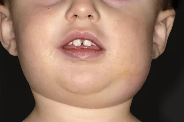 Kabakulak (mumps) IgM ve Kabakulak (mumps) IgG Testleri