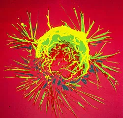 Kanserli Hücreler Laboratuvar Ortamında Öldürülebiliyor