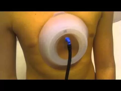 Vacuum Bell (Vakum Sistemi) Yöntemi: Pektus Ekskavatumda ( Kunduracı Göğüs) Ameliyatsız Tedavi 