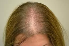 Tiroid Hastalarında Saç Dökülmesi Daha Çok Görülür