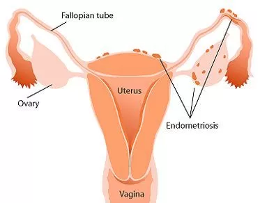 Endometriozis Ağrısına Tedavi Yöntemleri