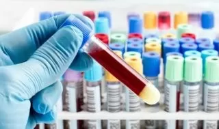 Kan Testi Nedir? Kan Testleri Nasıl Yaptırılır ve Hazırlanılır?