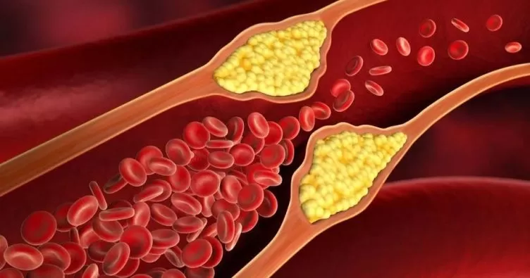 Kolesterol Testi Nedir? Kolesterol Normal Değerleri ve Kolesterol Yüksekliği 