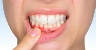 Diş Etlerinizi Sağlıklı Tutmanın 6 Yolu Nedir?