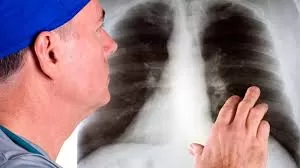 Akciğer Sertleşmesi Nedir?