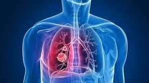 Akciğer Kanserinde İlk Belirtiler